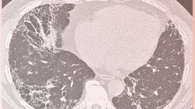 Listen to our experts explain the importance of proactive monitoring in patients with ILD